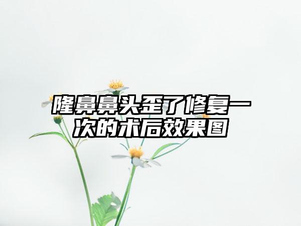 隆鼻鼻头歪了修复一次的术后效果图