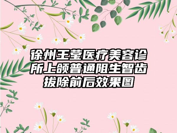 徐州王莹医疗美容诊所上颌普通阻生智齿拔除前后效果图