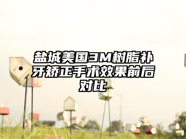 盐城美国3M树脂补牙矫正手术效果前后对比