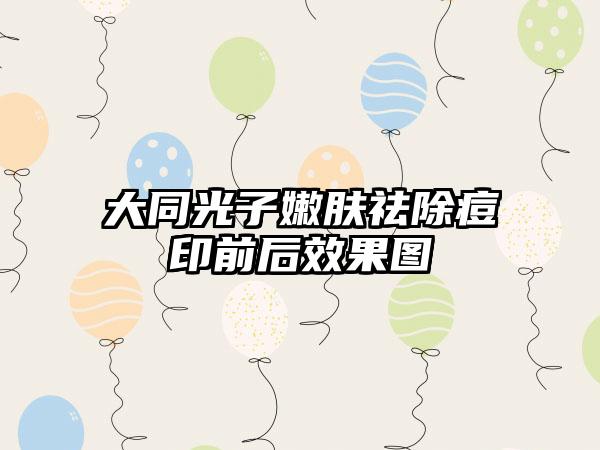 大同光子嫩肤祛除痘印前后效果图