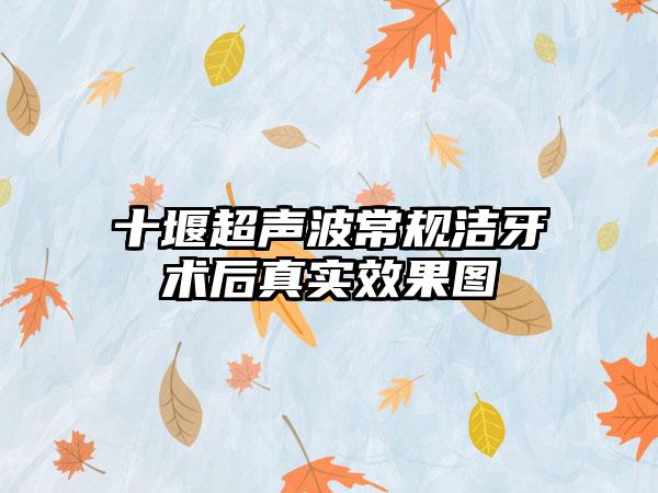 十堰超声波常规洁牙术后真实效果图