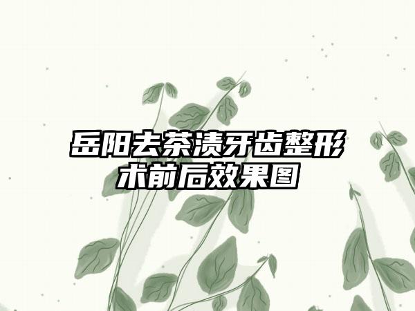 岳阳去茶渍牙齿整形术前后效果图