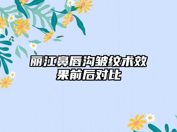 丽江鼻唇沟皱纹术效果前后对比