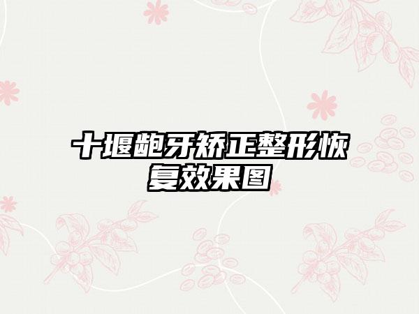 十堰龅牙矫正整形恢复效果图