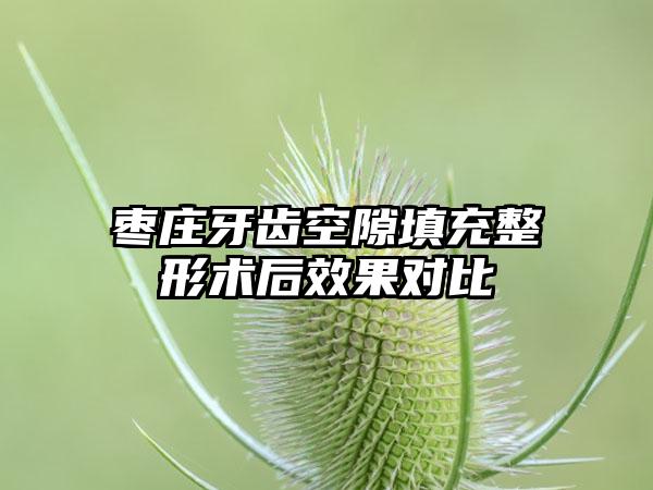 枣庄牙齿空隙填充整形术后效果对比