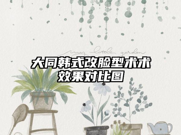 大同韩式改脸型术术效果对比图